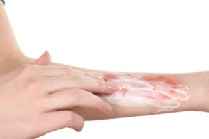 Burn Wounds