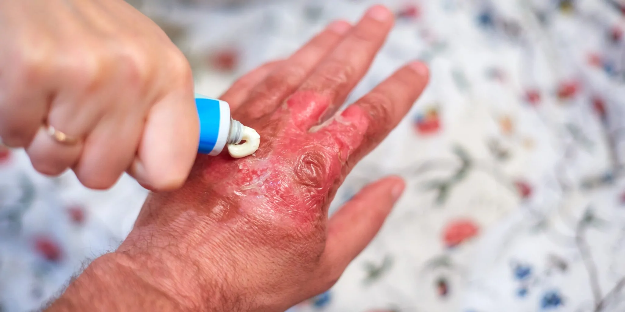 Chemical Burn — hero image