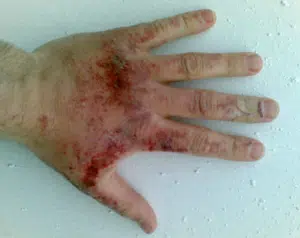 Chemical Burn — before