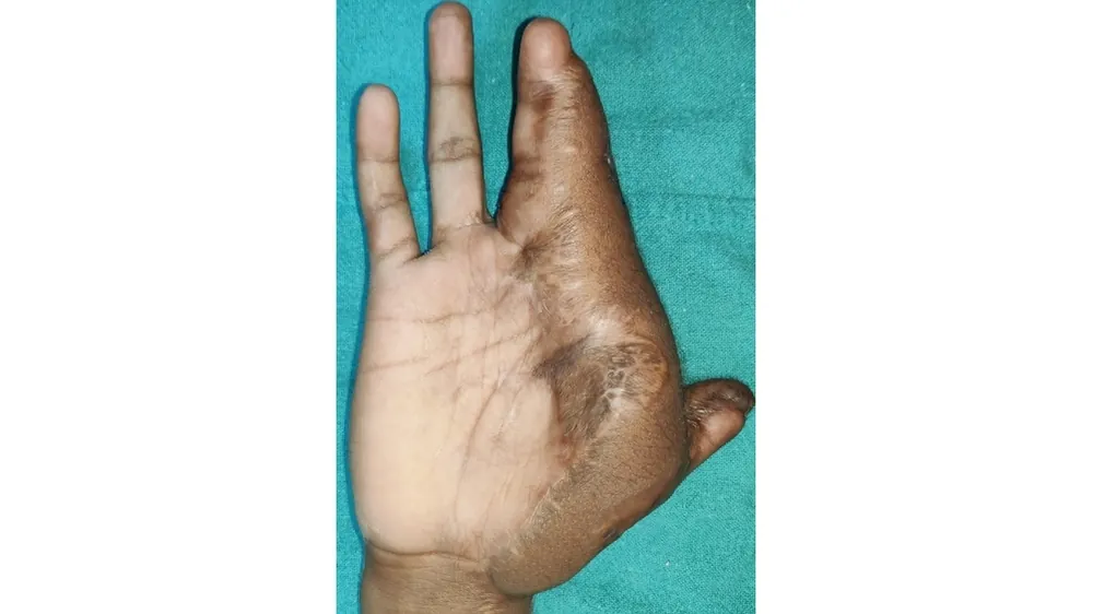 After surgery