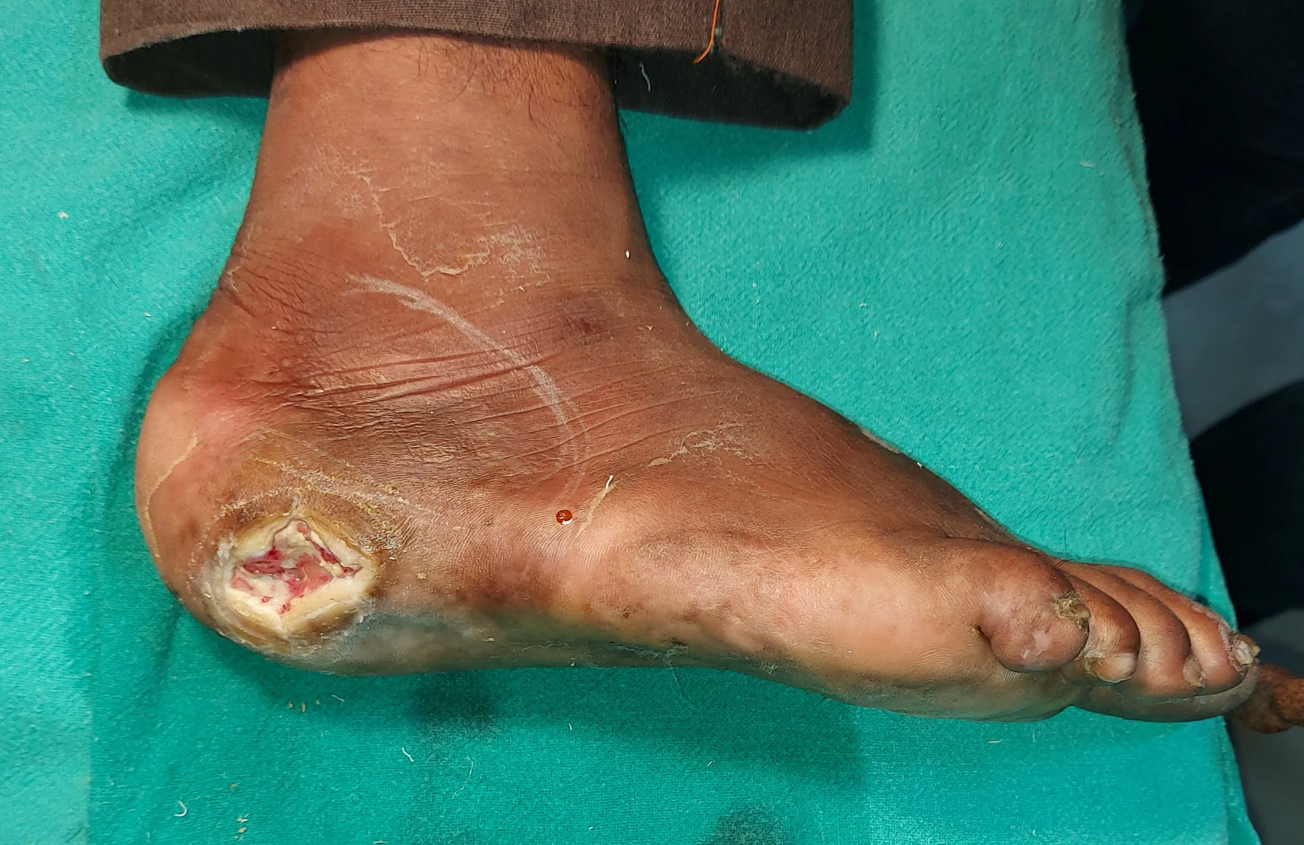 Diabetic Foot Infections — before