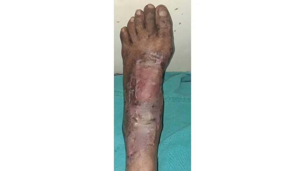 Diabetic Foot Infections — after