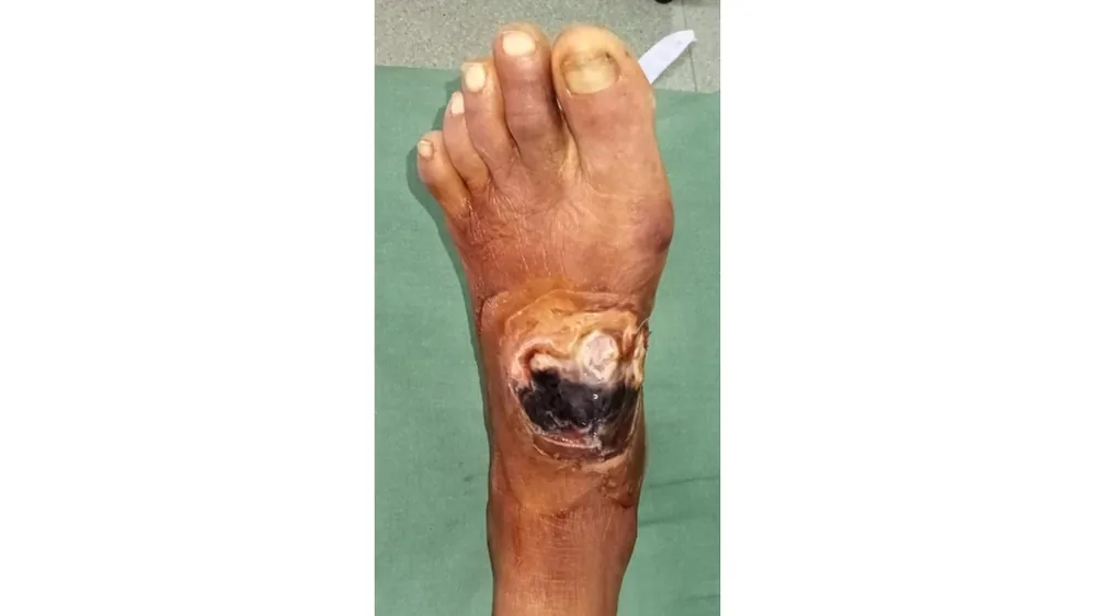 Diabetic Foot Infections — before