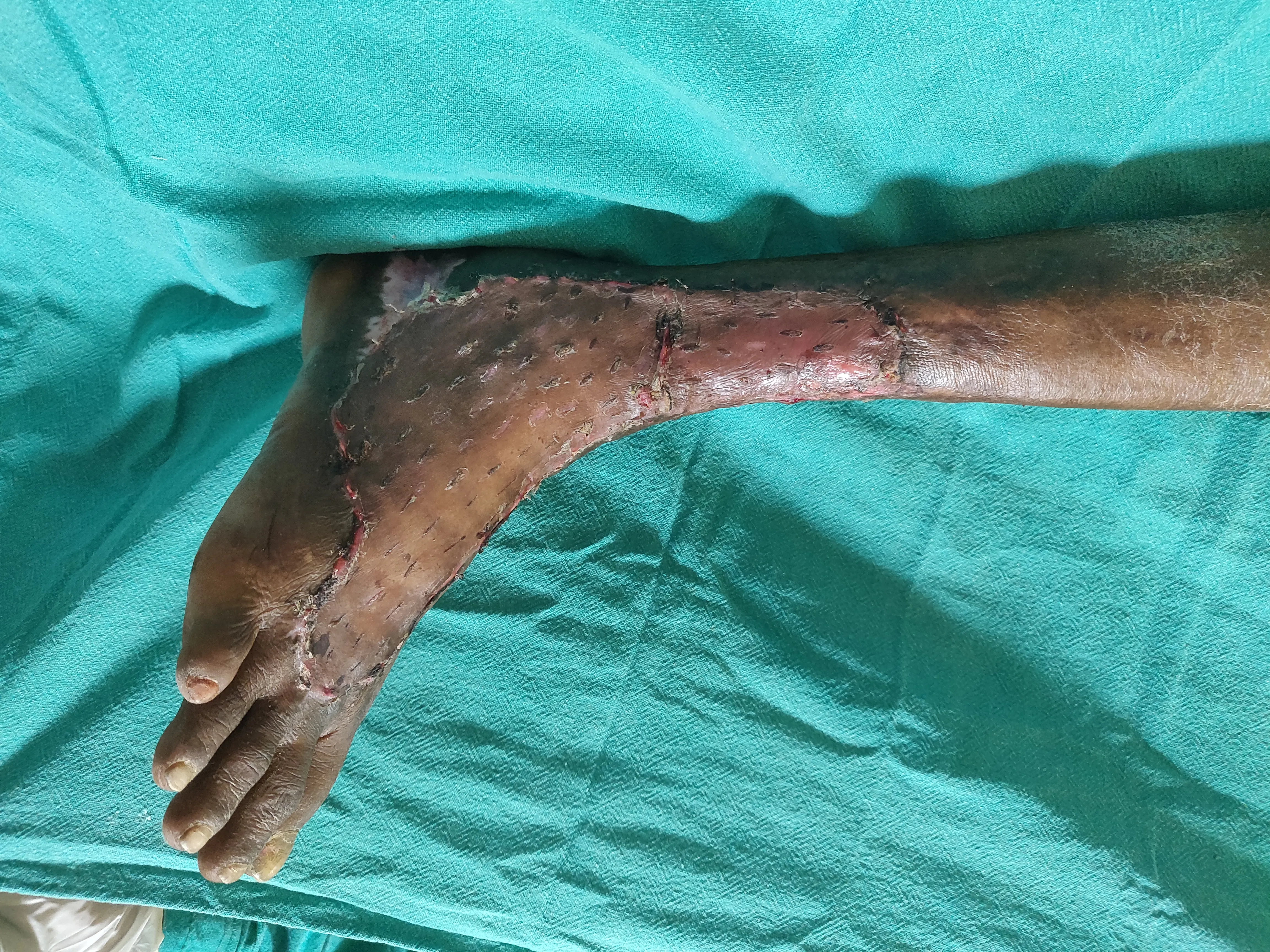 Diabetic Foot Infections — after