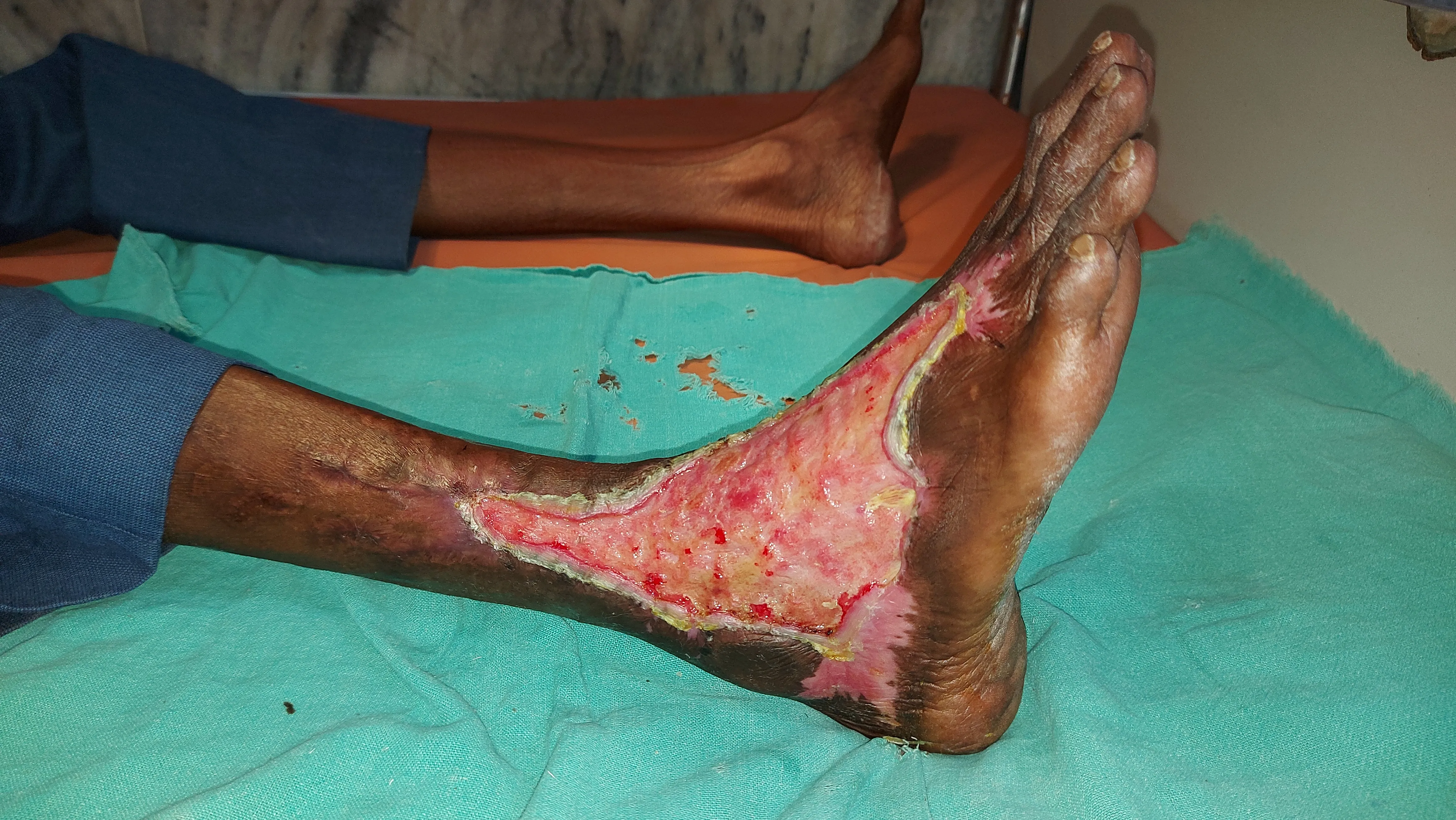 Diabetic Foot Infections — before