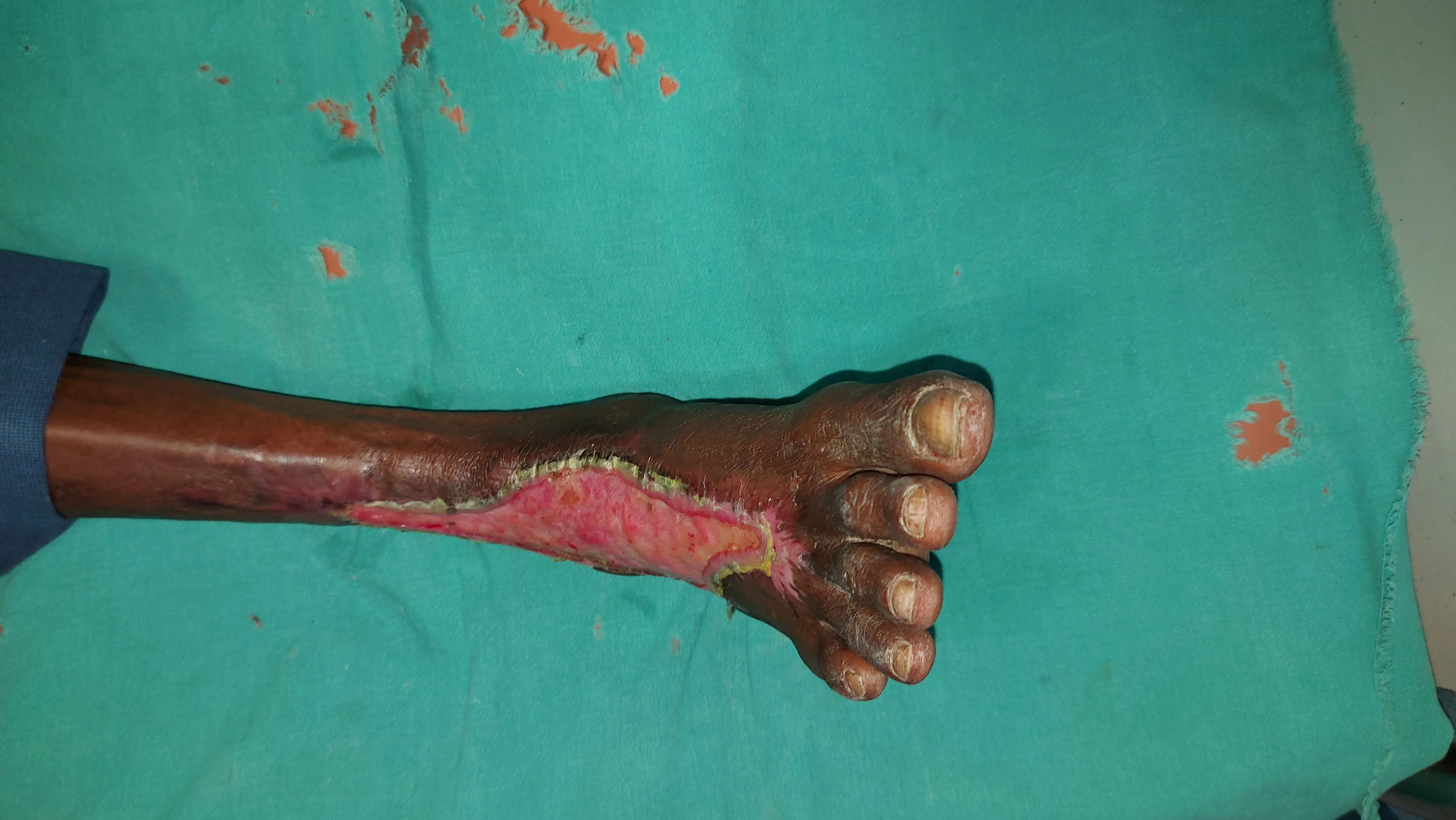 Diabetic Foot Infections — before