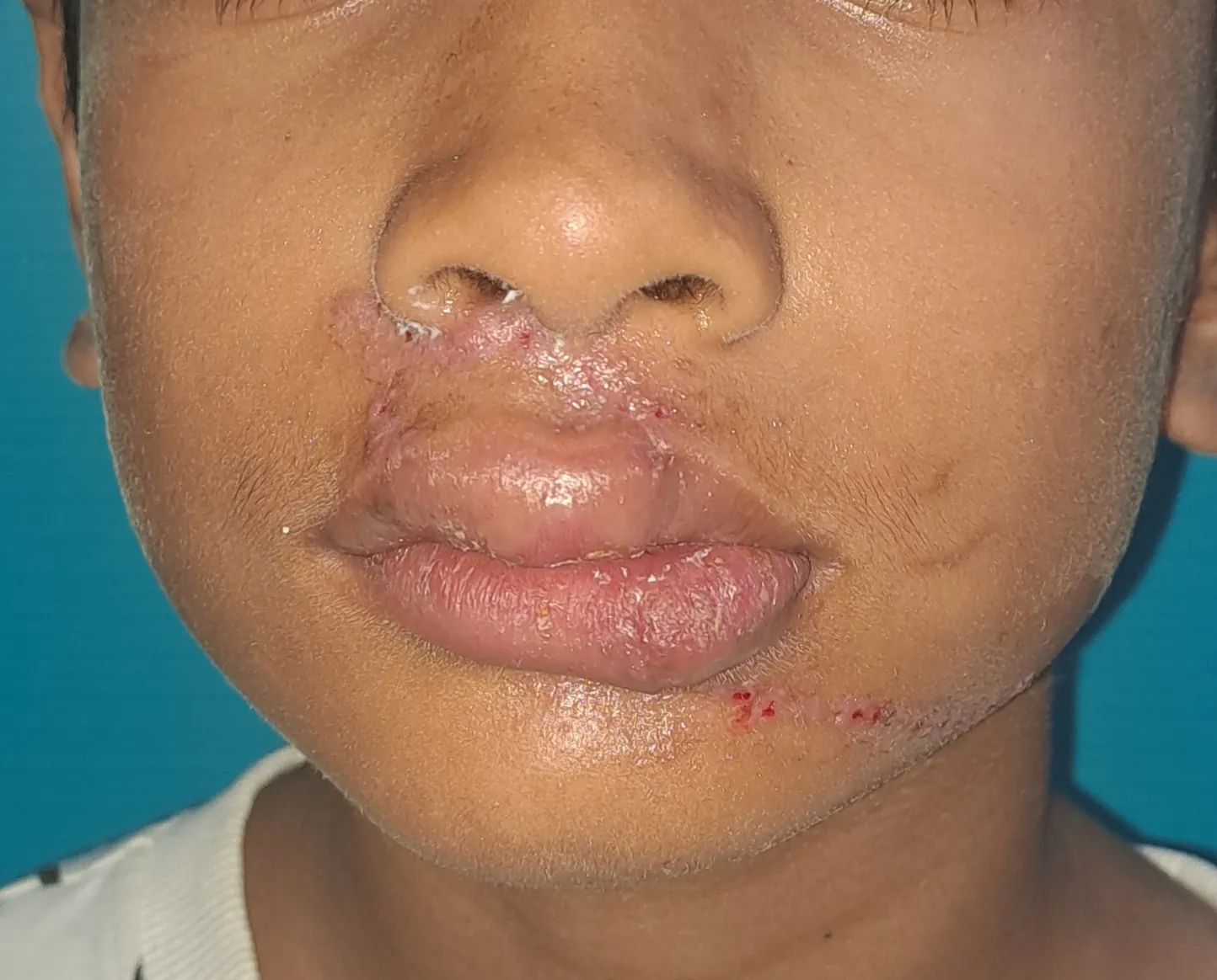 After surgery