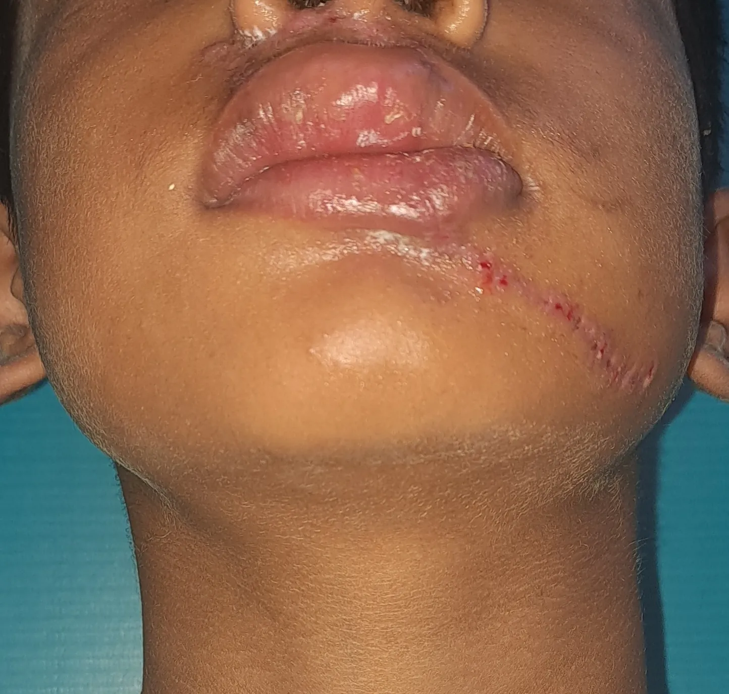 After surgery