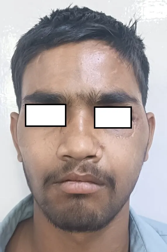 After surgery
