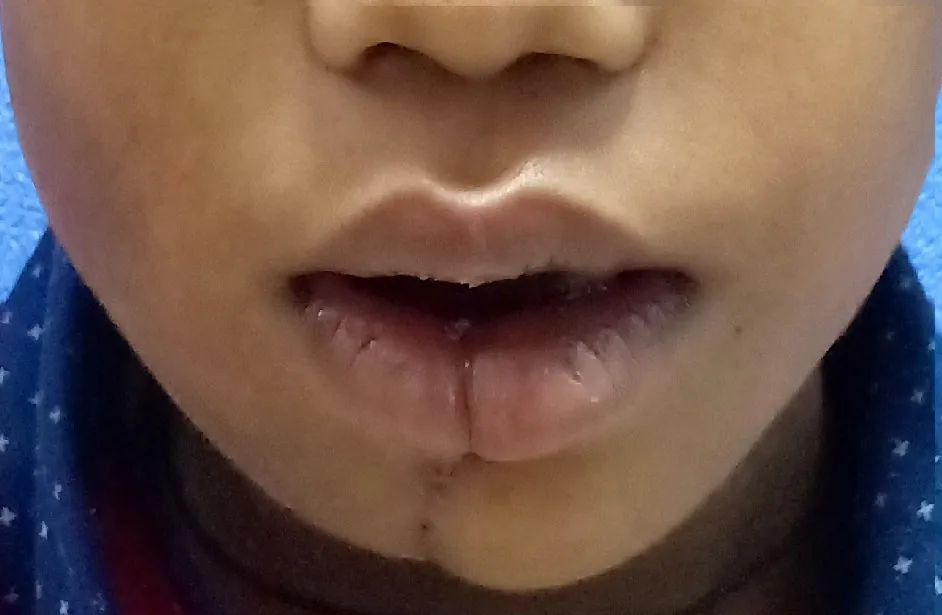 After surgery