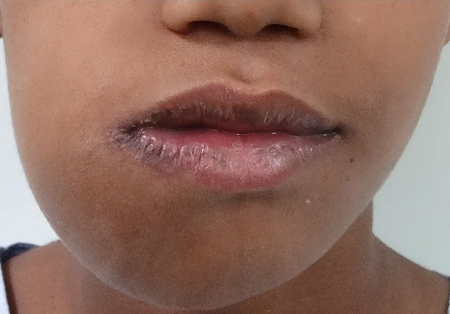 Before surgery