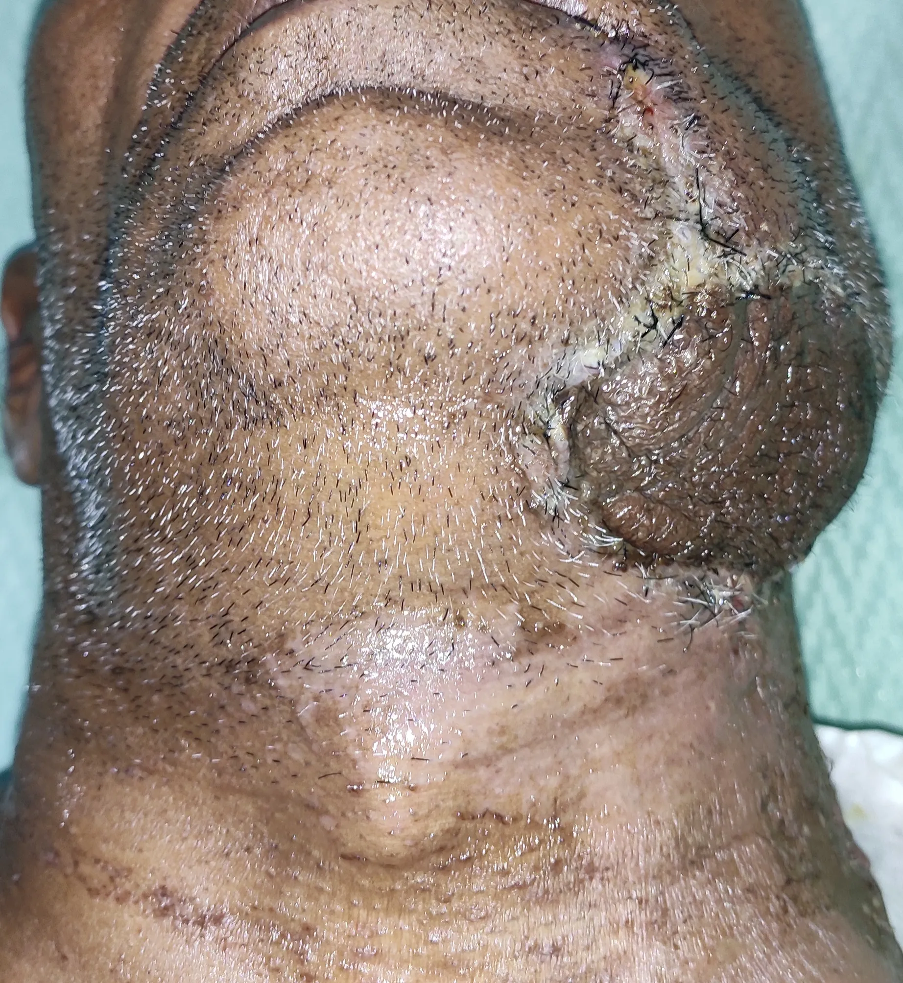 After surgery