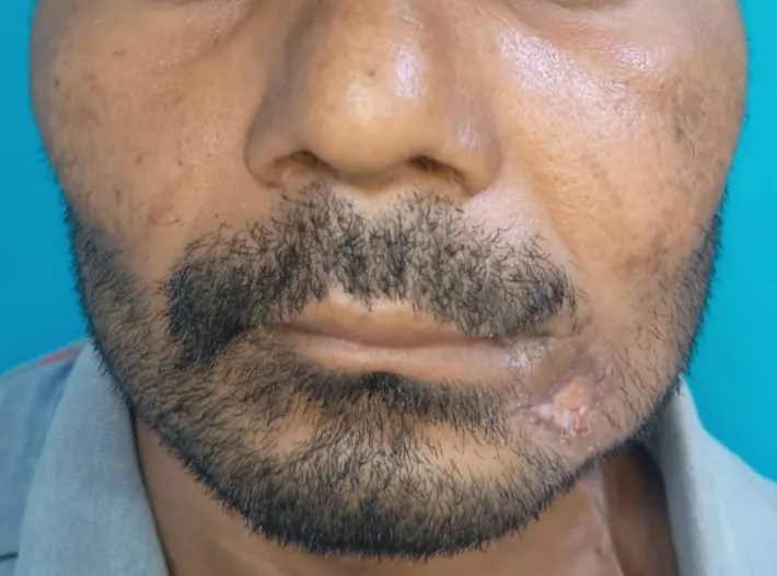 After surgery