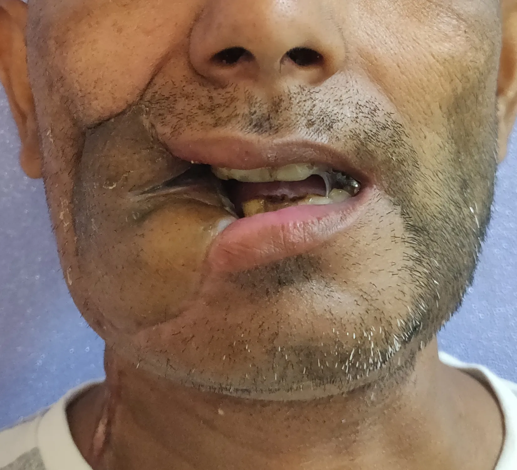 After surgery