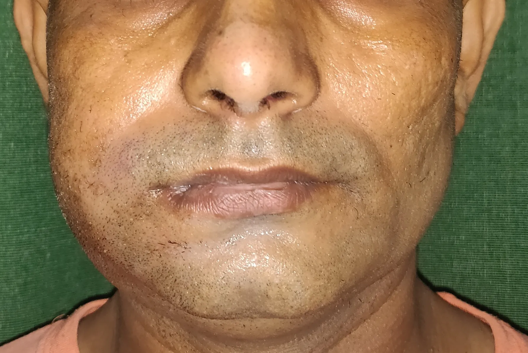 Before surgery