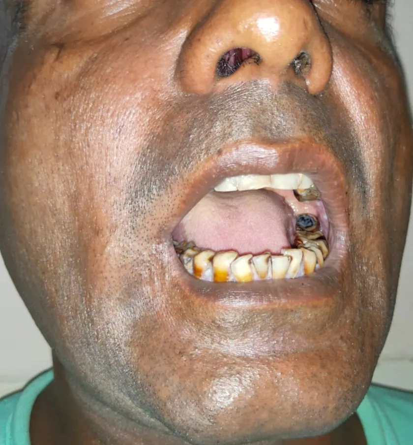 Before surgery