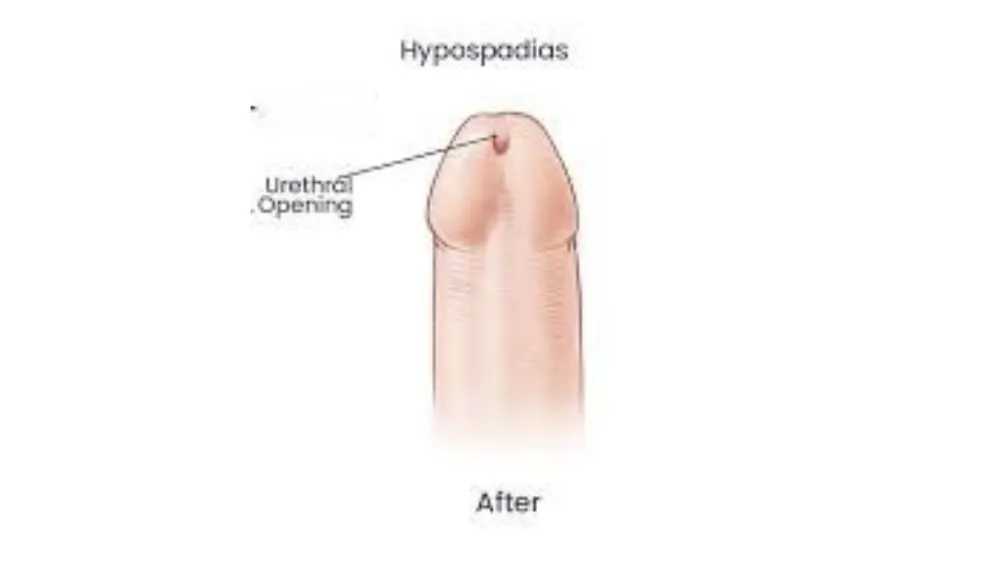 After surgery