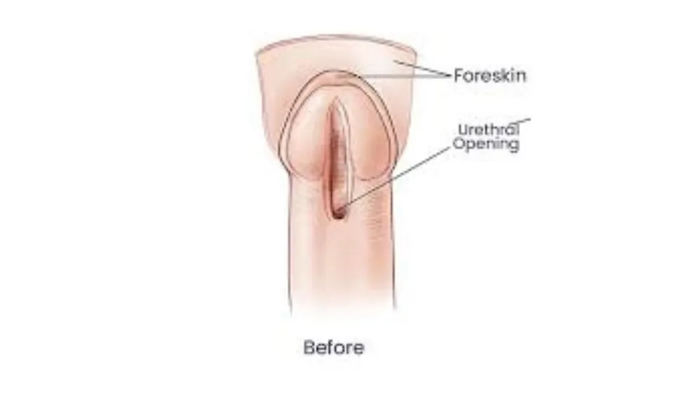 Before surgery