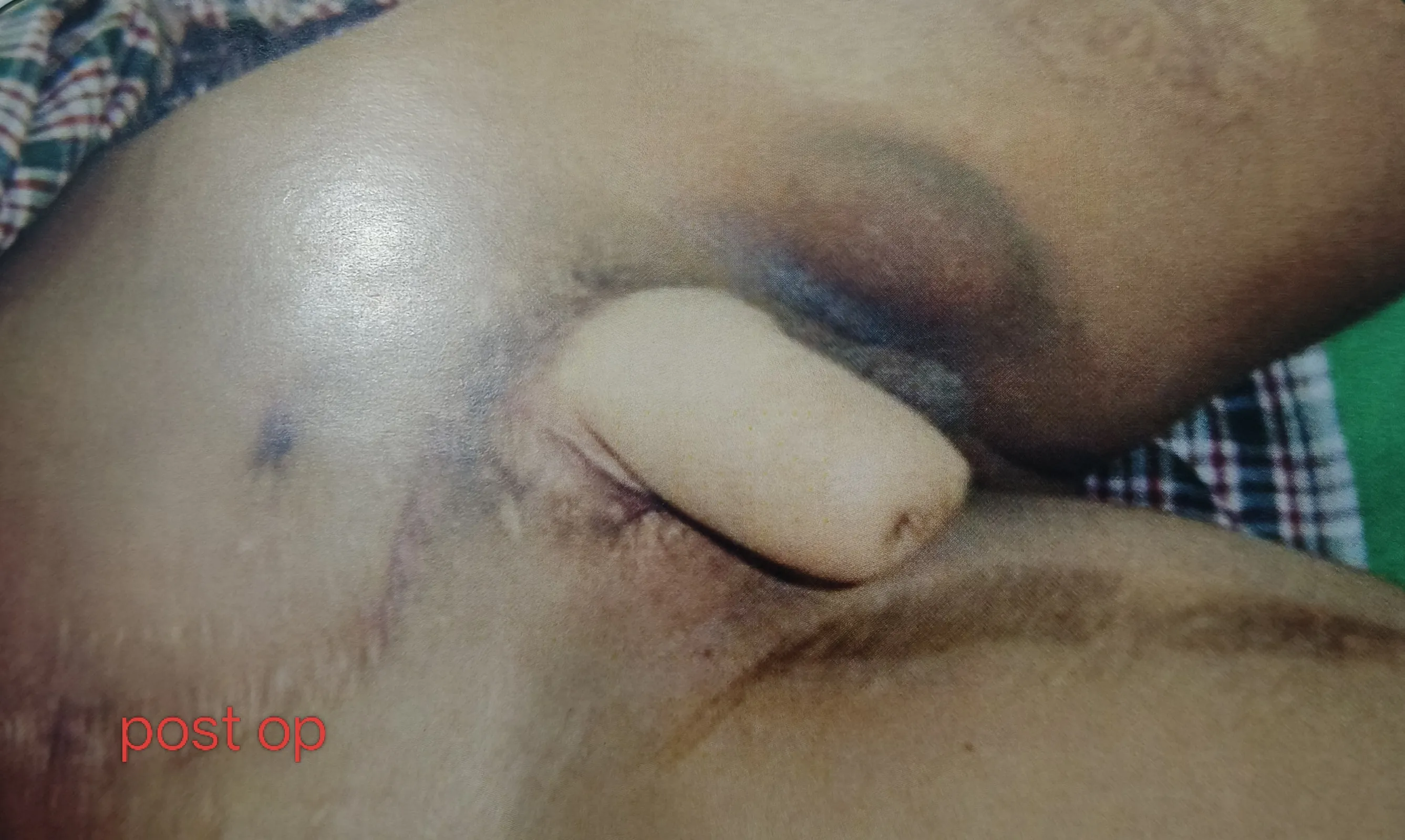 Penis Reconstruction — after