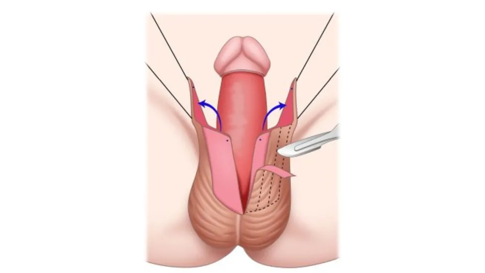 Understanding Scrotum & Penile Skin Reconstruction
