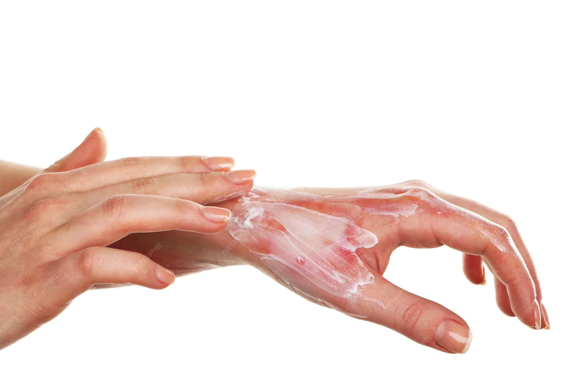 Blast/Cracker Injury Hand — hero image