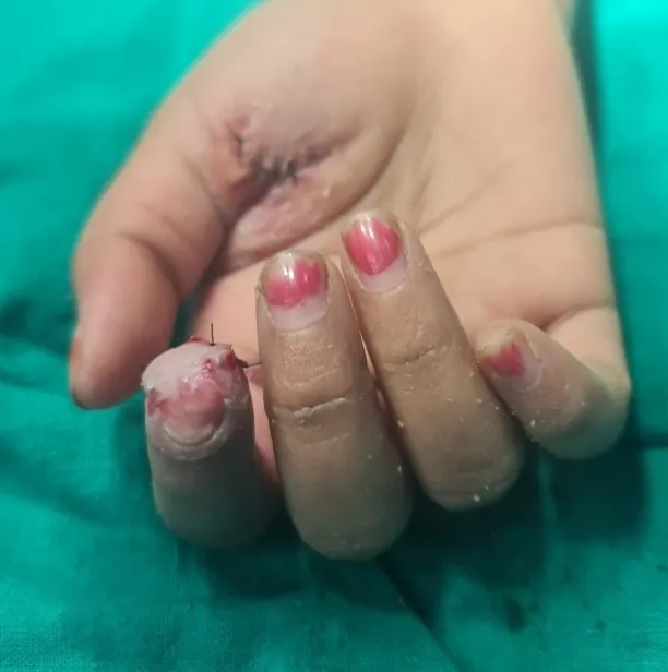 Fingertip Injuries — after