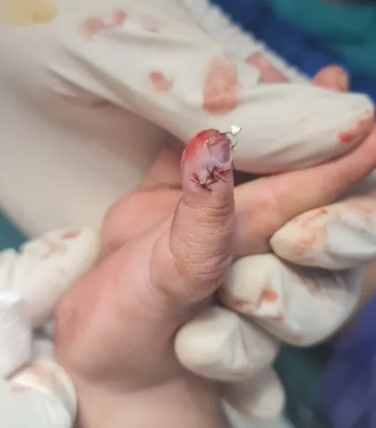 Fingertip Injuries — after
