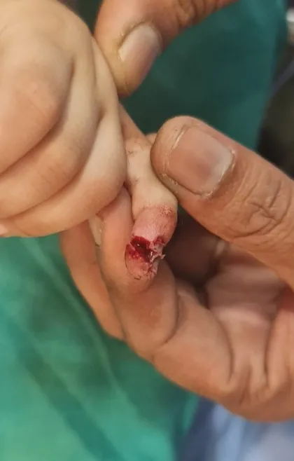 Fingertip Injuries — before