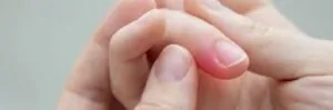 Fingertip Injuries