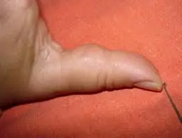 Fingertip Injuries