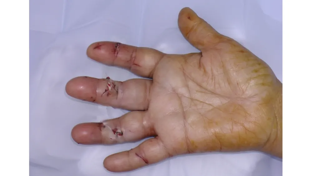 Hand Fracture — after