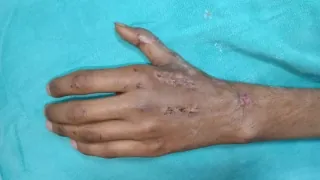 Hand Fracture — after
