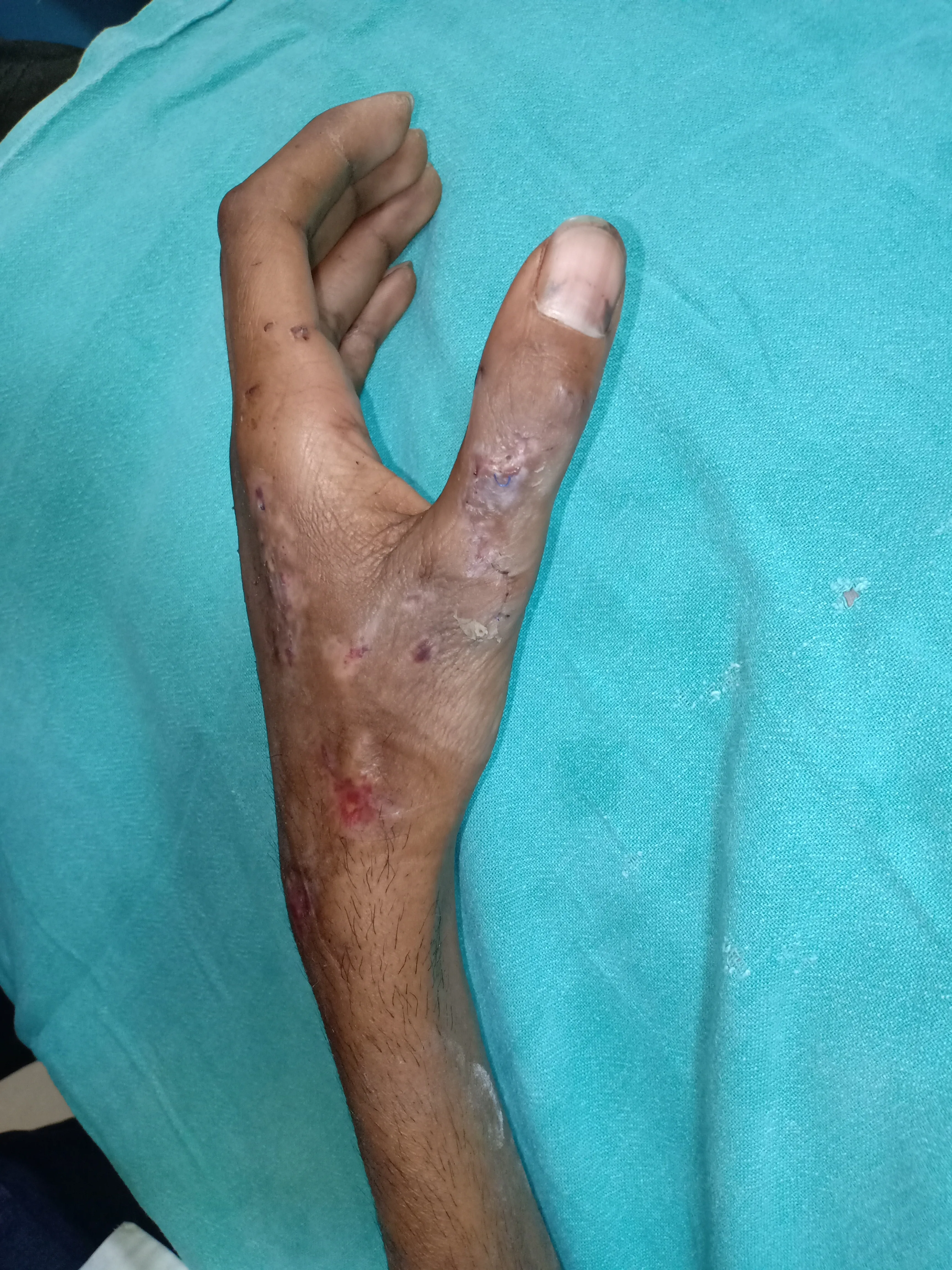 Hand Fracture — after