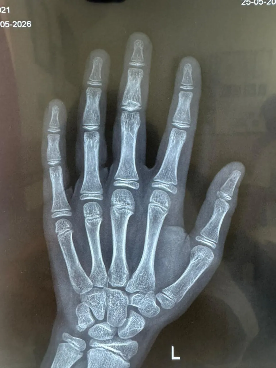 Hand Fracture — after