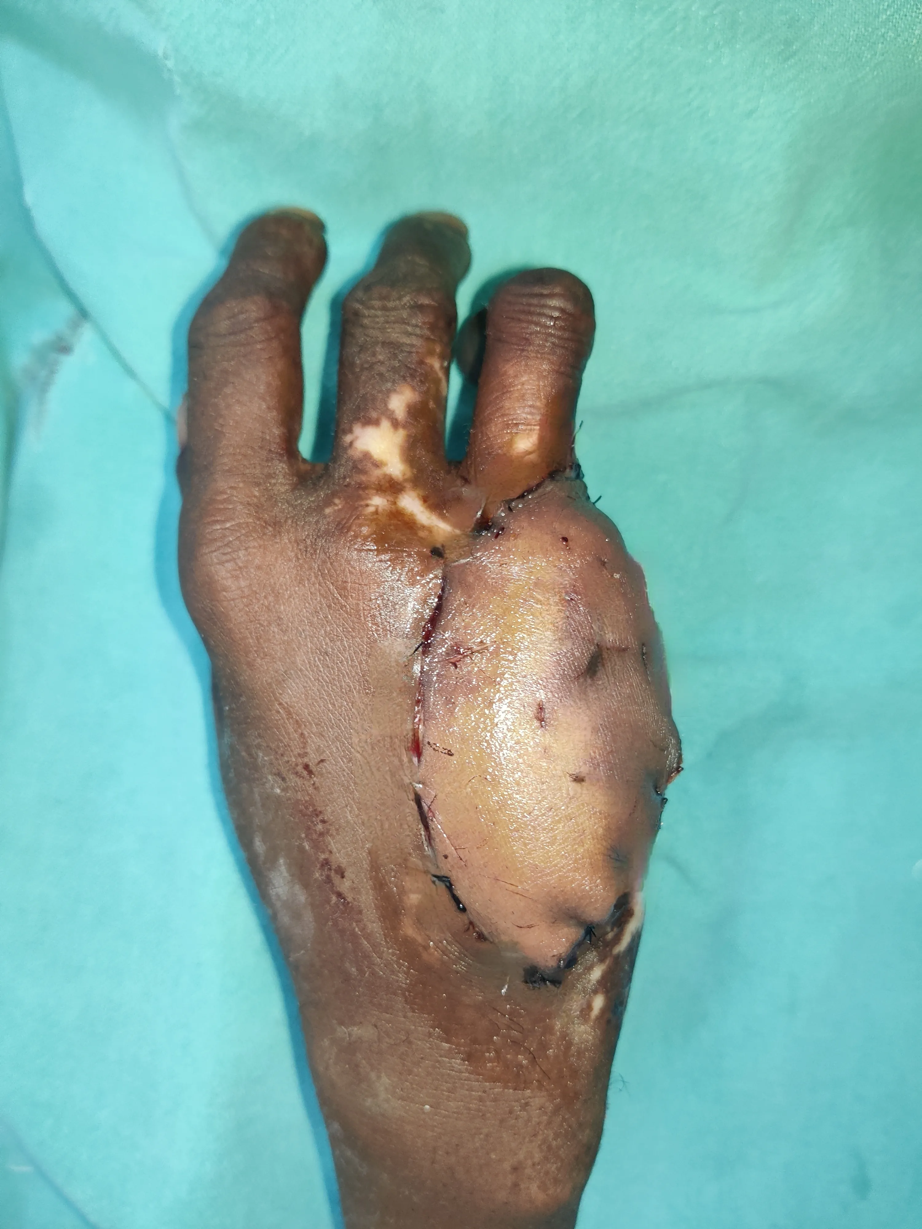 After surgery