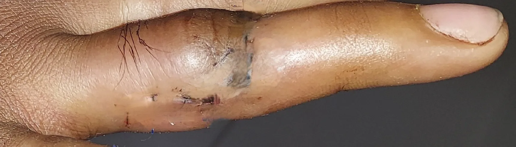 After surgery