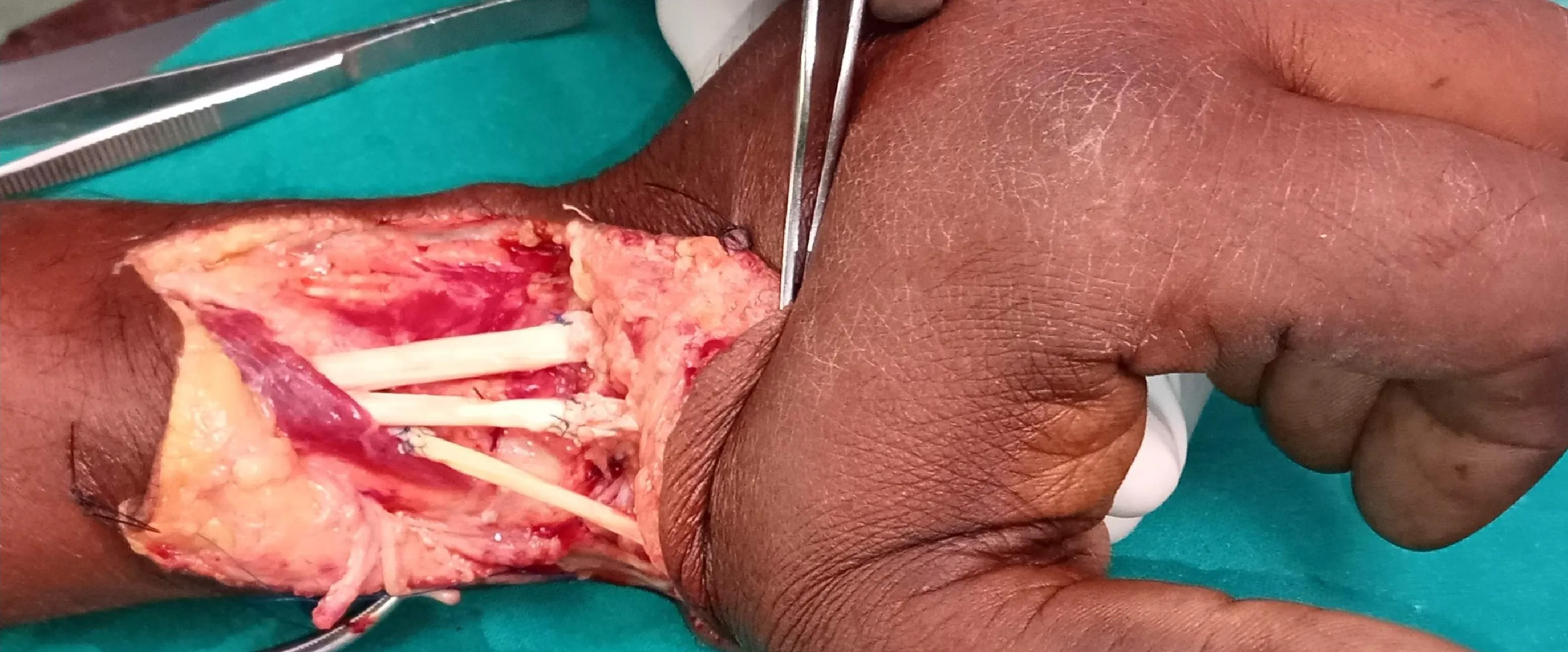 Tendon Artery Nerve Damage — after