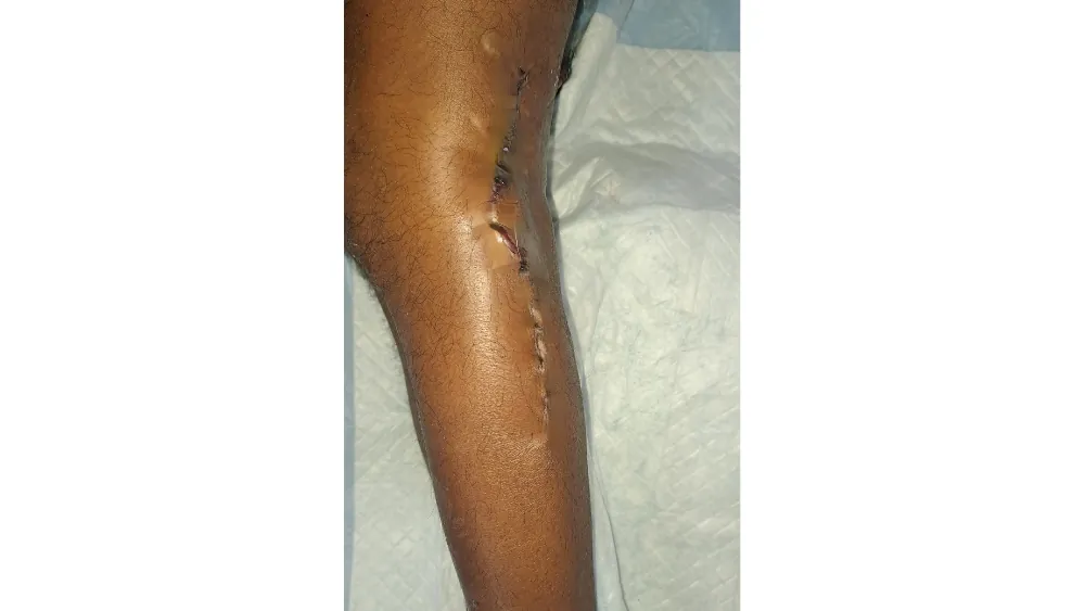Tendon Artery Nerve Damage — after