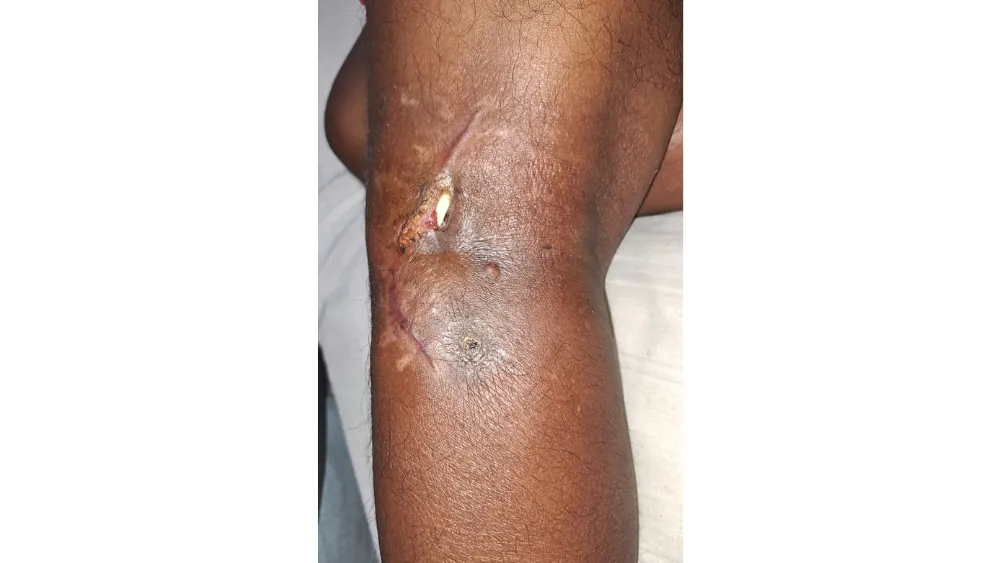 Tendon Artery Nerve Damage — before