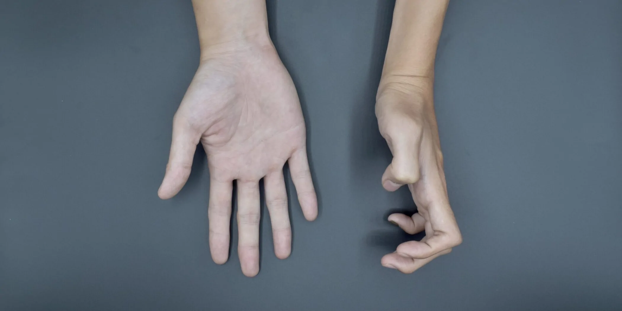 Cerebral Palsy Hand Deformity — hero image