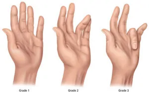 Dupuytren's Contracture