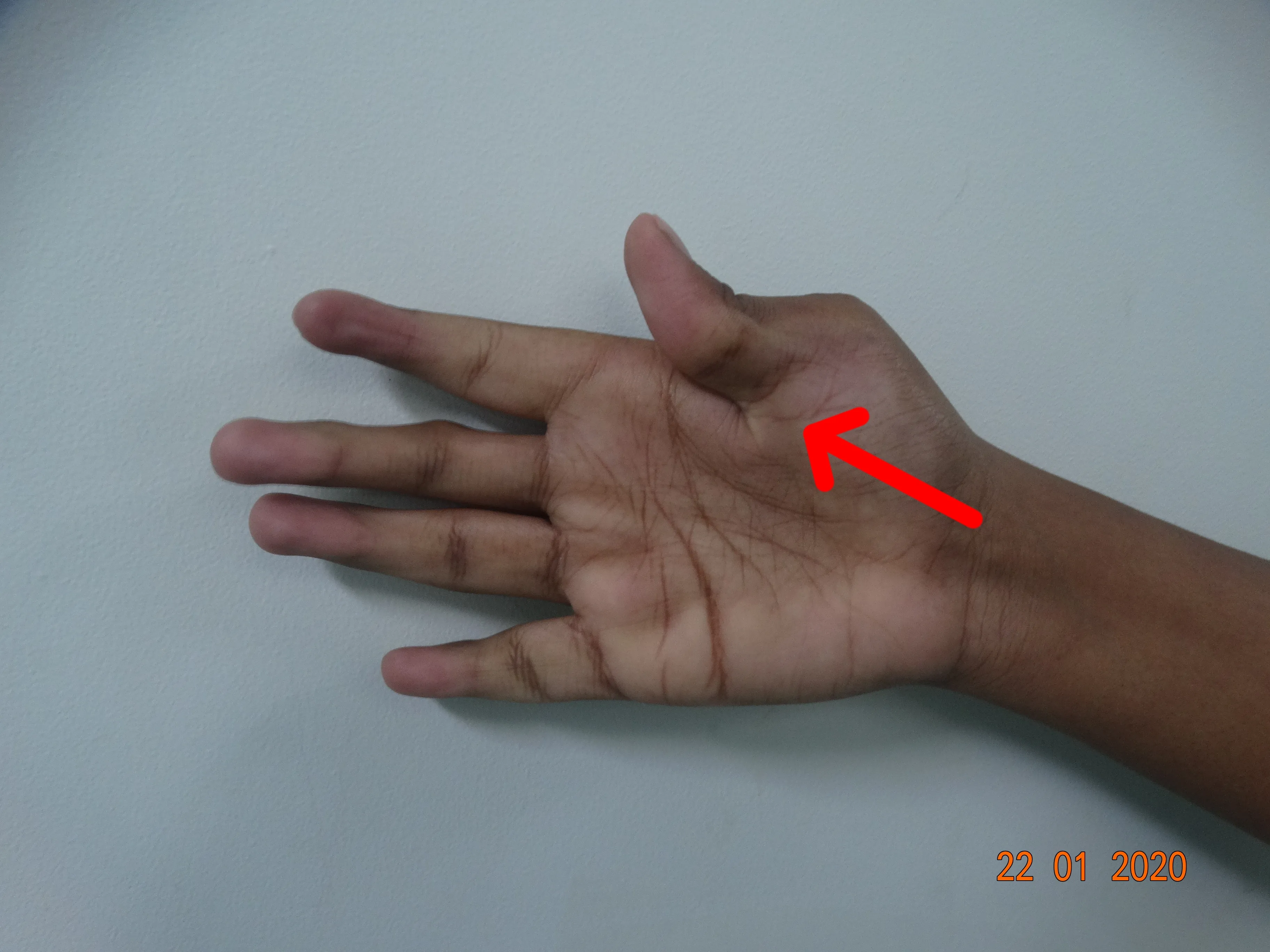 Before surgery