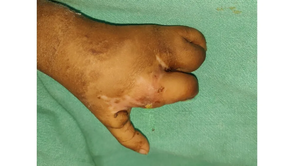After surgery