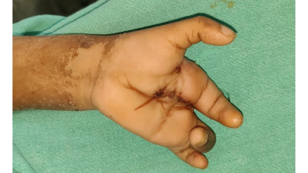 After surgery
