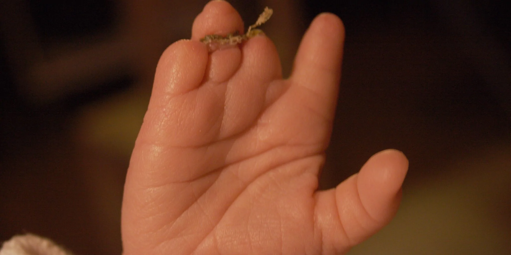 Constriction Ring Syndrome in Babies — hero image