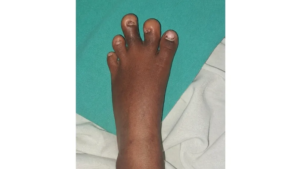 After surgery