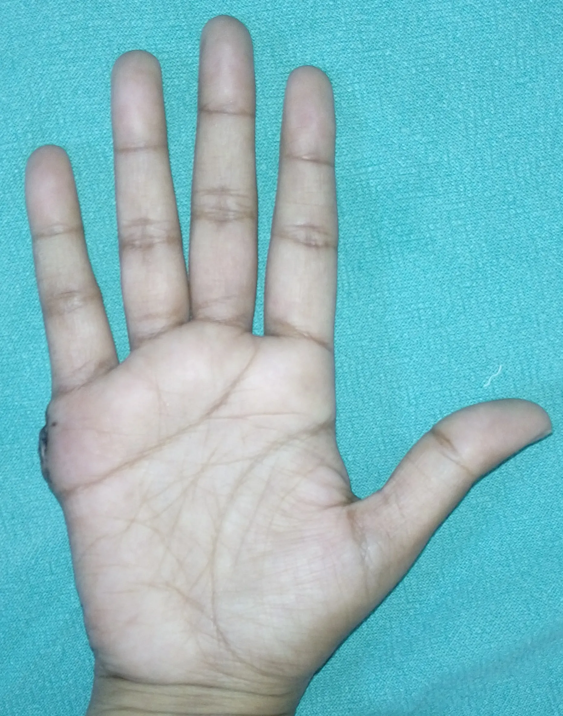 After surgery