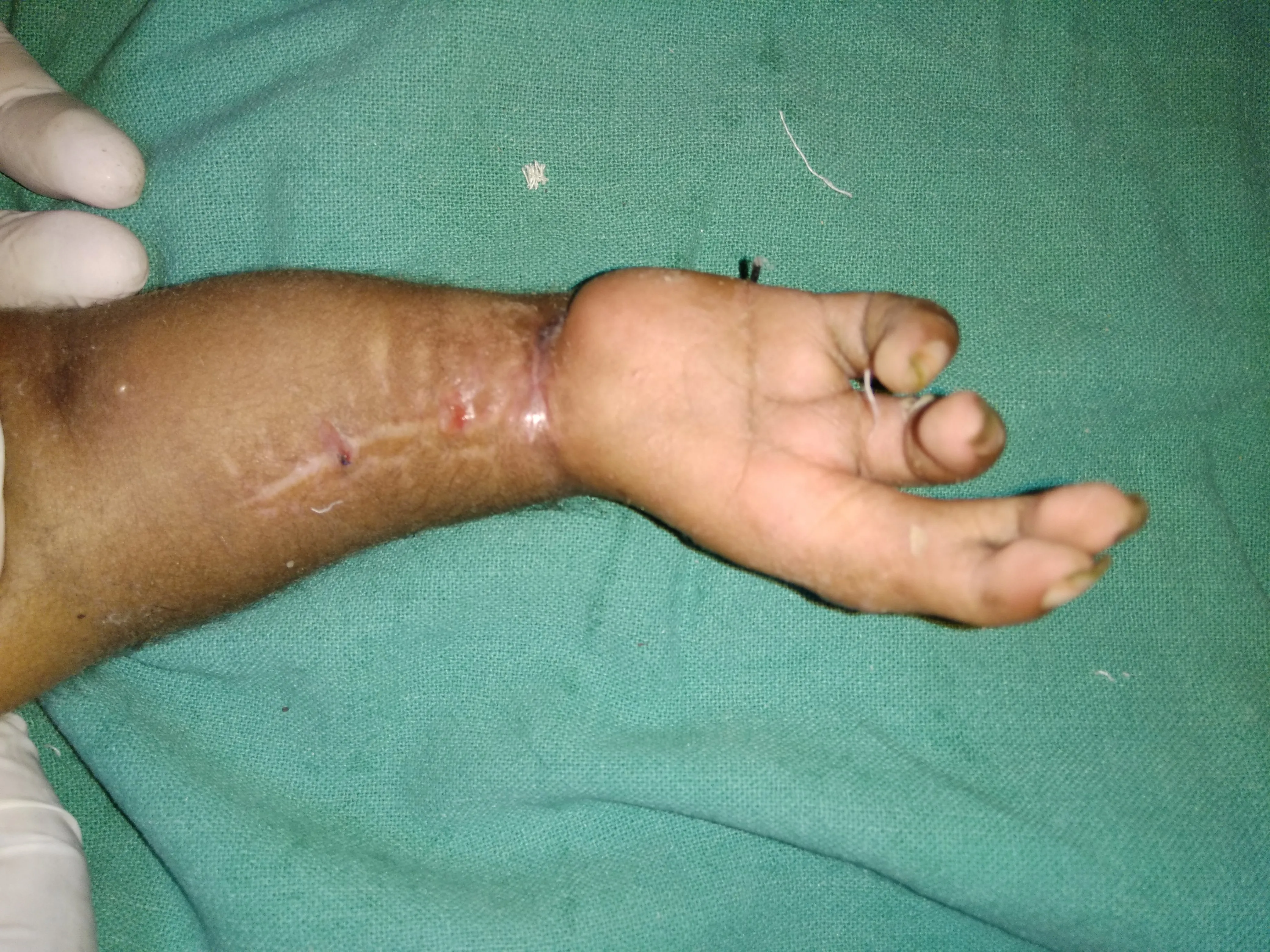 After surgery