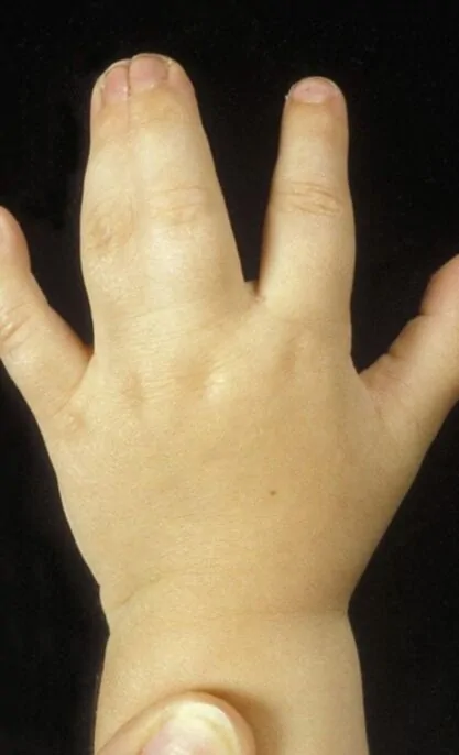Hand Birth Defect procedures at Kayakriti