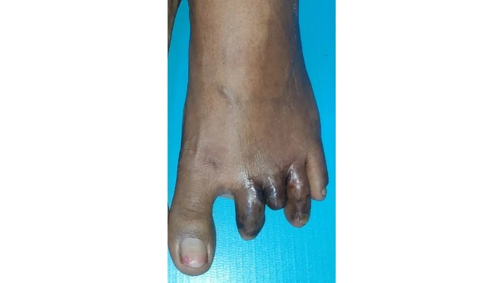 After surgery